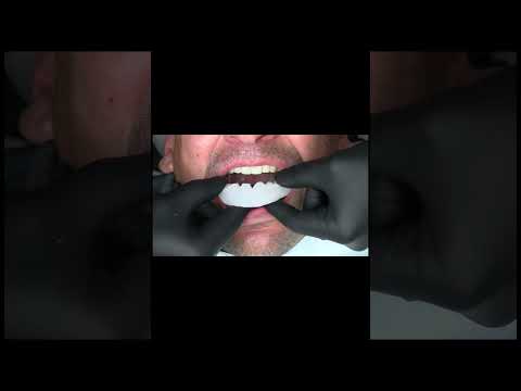 Best Composite Bonding  by Advanced Smiles Dentistry Tijuana Mexico