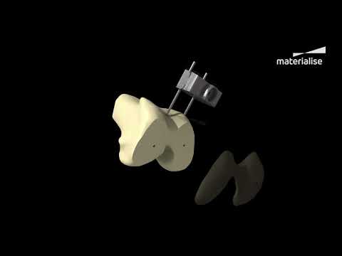 Patient-Specific 3D-Printed Knee Guides | Materialise Medical