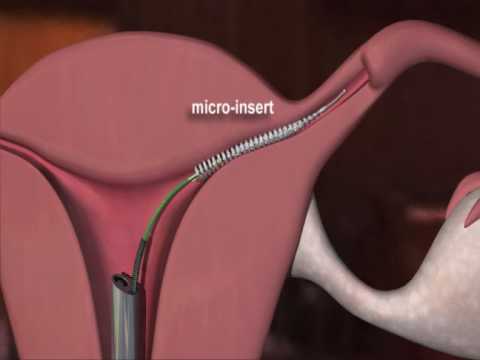 Female Sterilization Procedure