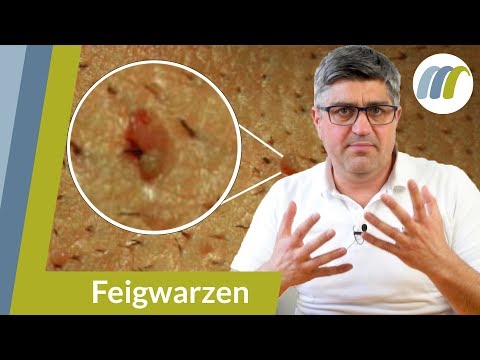 Warzen am Penis? - So gehen sie wieder weg | Urologie am Ring