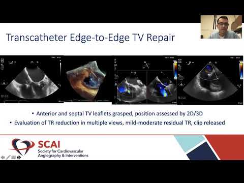 Mitral and Tricuspid Valve Transcatheter Edge-to-Edge Repair