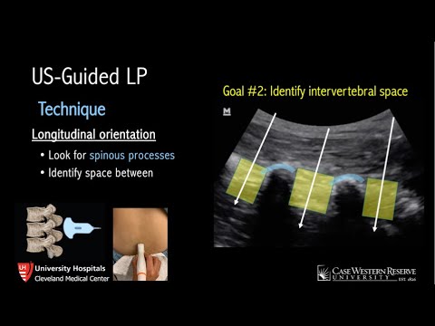 Ultrasound-Guided Lumbar Puncture