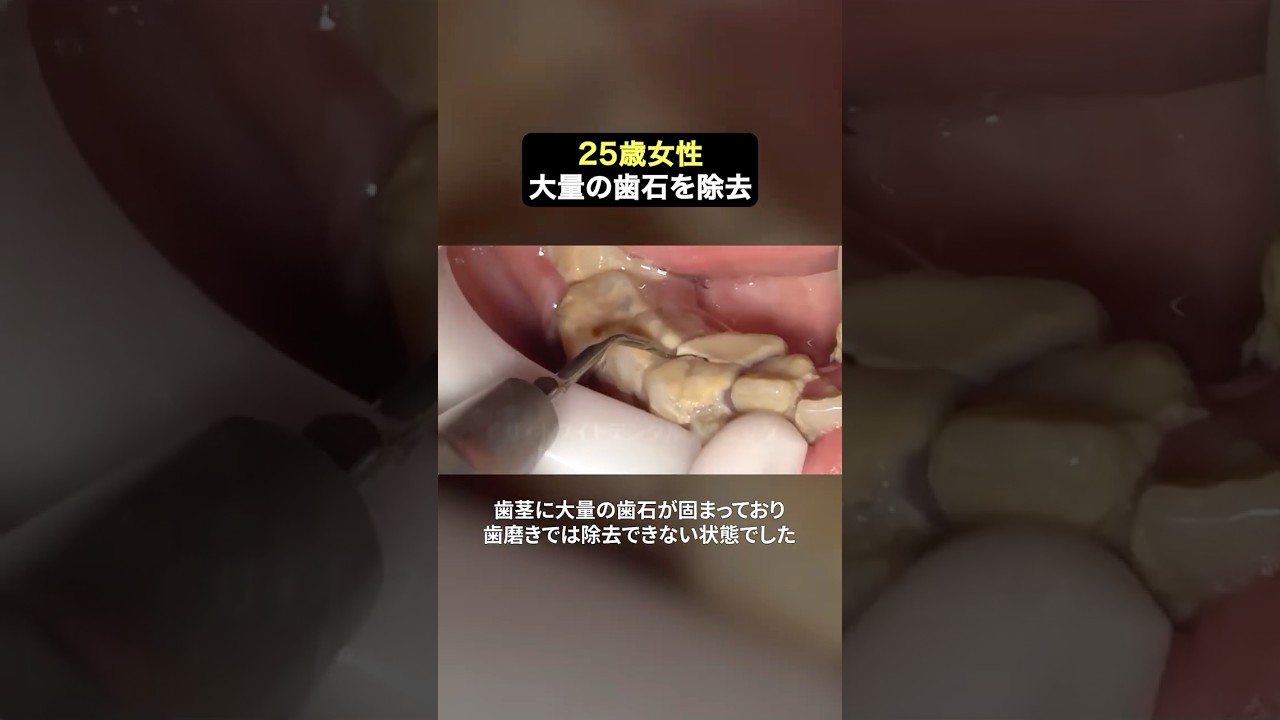 大量歯石をごっそり除去✨#ザホワイトデンタルクリニック  #歯医者  #歯石除去