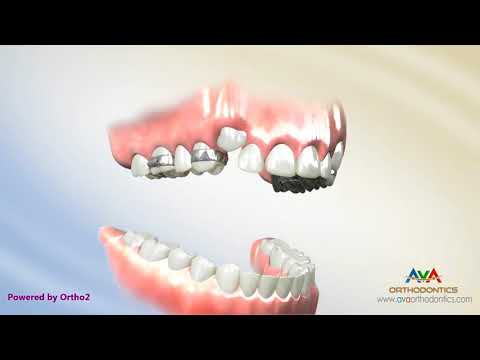 Orthodontic Expander or Spacer - Crossbow Appliance