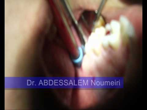 comment soulager douleur apres extraction dents sagesse