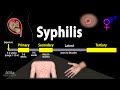 Syphilis Pathophysiology Diagnosis And Treatments Animation