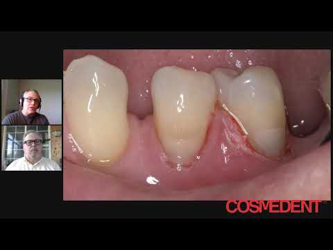 How to Make Cervical Restorations Invisible with Opaquers
