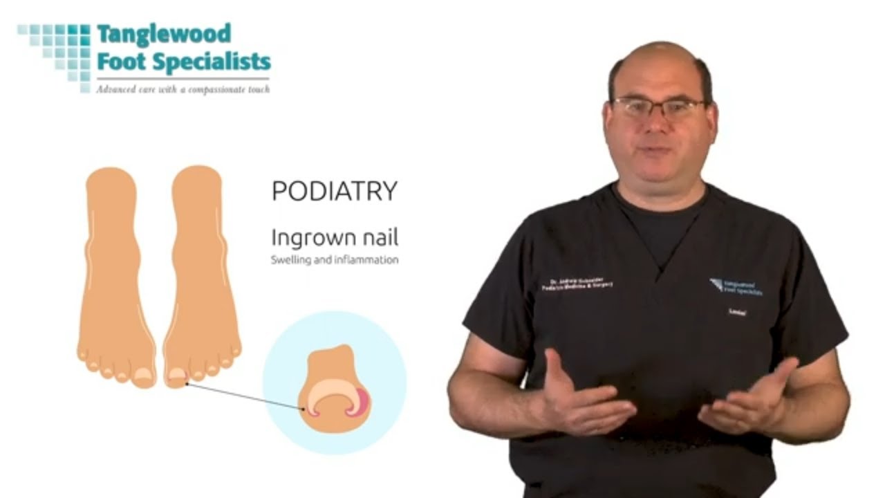 Ingrown Toenails Explained