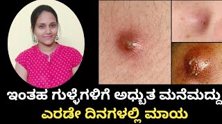 ಕುರುವಿಗೆ ಅಧ್ಬುತ ಮನೆಮದ್ದು || Home remedies for Heat Boils in Kannada ||How to get rid of heat pimples