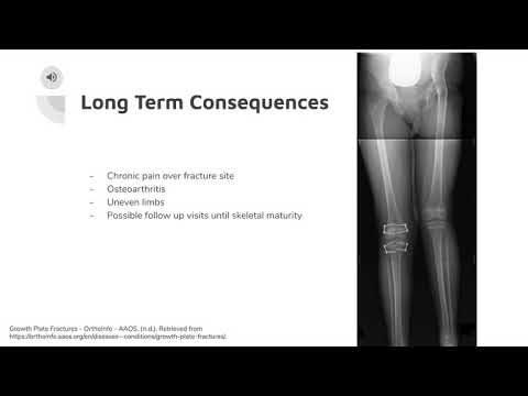 Epiphyseal Plate Fracture