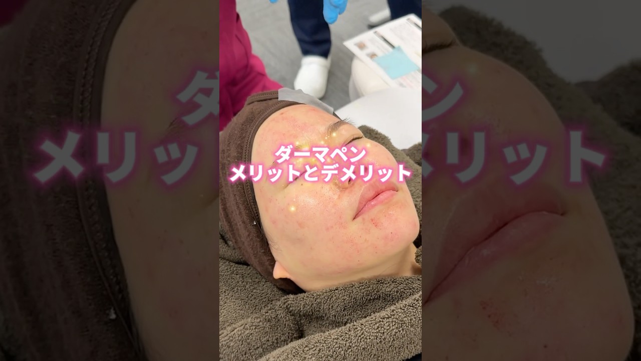 ダーマペンのメリットとデメリット