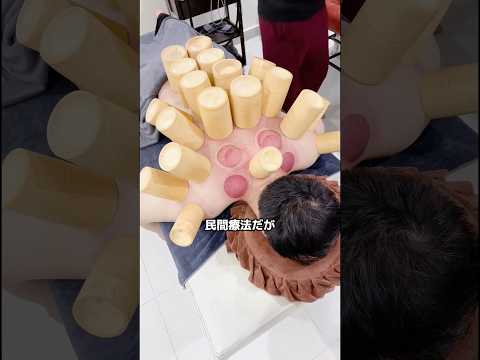 カッピングの効果はあるのか