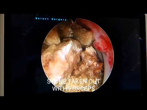 PCNL SURGERY FOR LARGE KIDNEY STONE| Dr. S k. palash