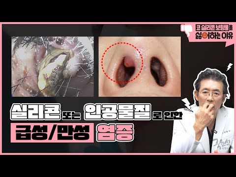 실제 사례로 보는 "내가 코 실리콘 보형물을 싫어하는 이유" #2 #코보형물제거 #코실리콘제거 #코재수술