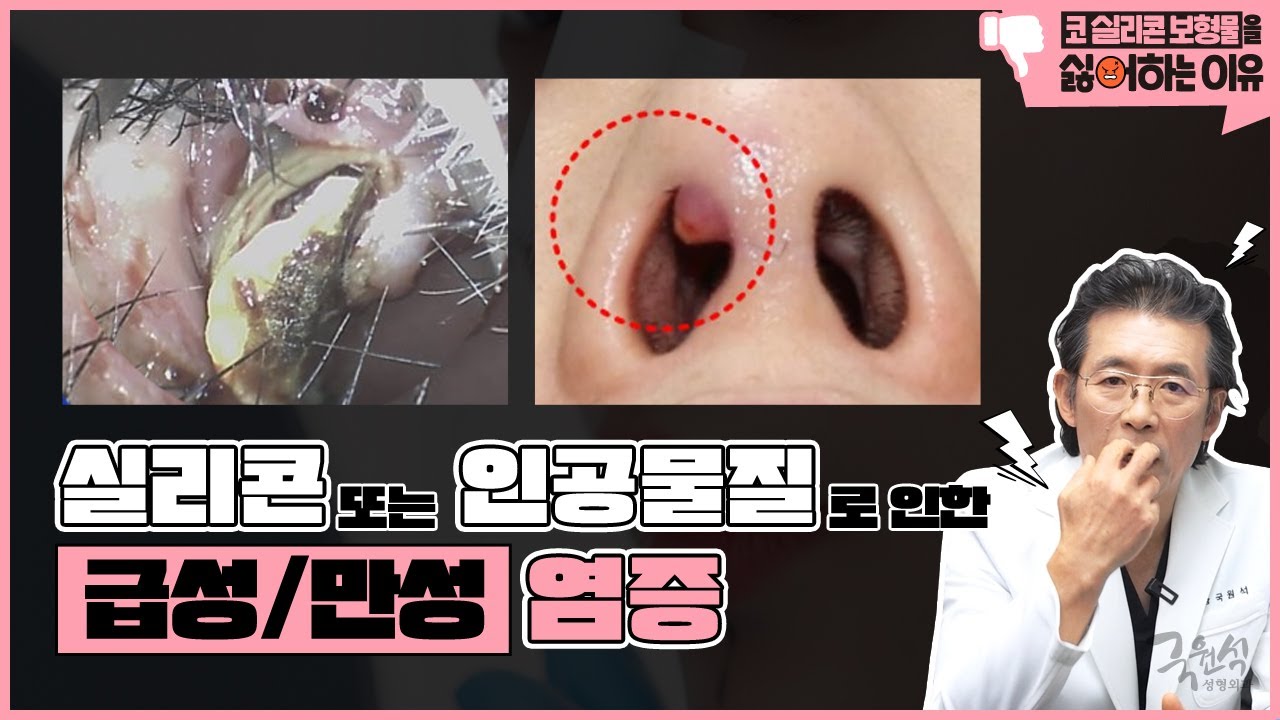 실제 사례로 보는 "내가 코 실리콘 보형물을 싫어하는 이유" #2 #코보형물제거 #코실리콘제거 #코재수술 썸네일