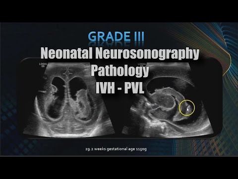 image-What is Neurosonography?