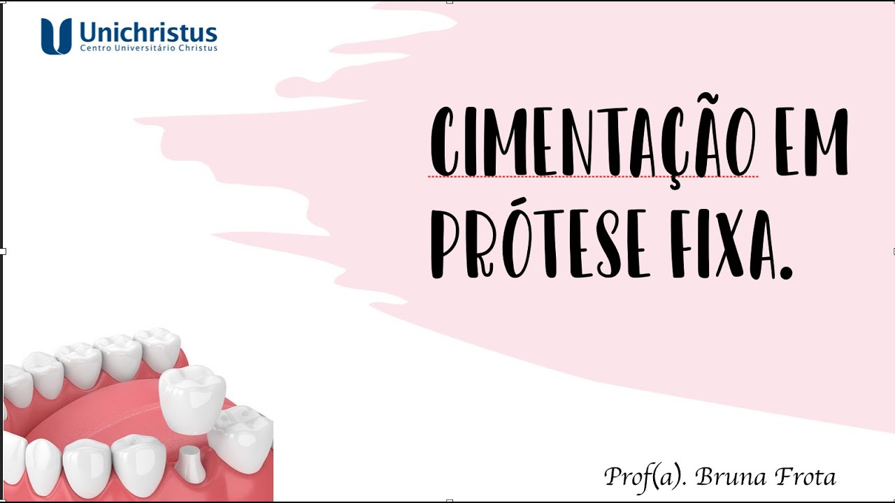 Cimentação em Prótese Fixa