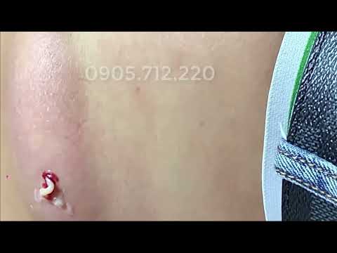 Popping a large CYST filled with pus.