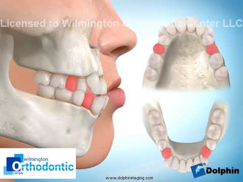 Four-bicuspid Extraction Upper 2nd Lower 1st