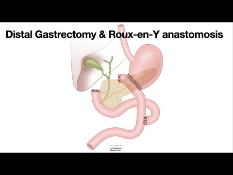 HCC 1475-10d-Surgical Anatomy-Roux en Y