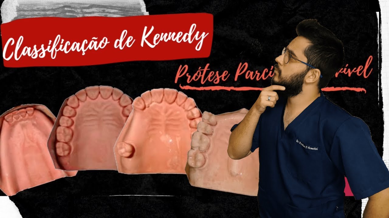 Classificação de Kennedy (PPR) + Regras de Applegate