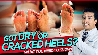 A Diabetic Skin Problem: Dry, Cracked Heels. Causes & Remedies.