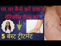 पाँवो की नस फूल जाने  (Varicose Veins) का इलाज  Varicose Veins treatment by Dr Nikita