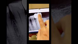 Endo-perio presentation. #dentists #dentalcare #rootcanaltherapy