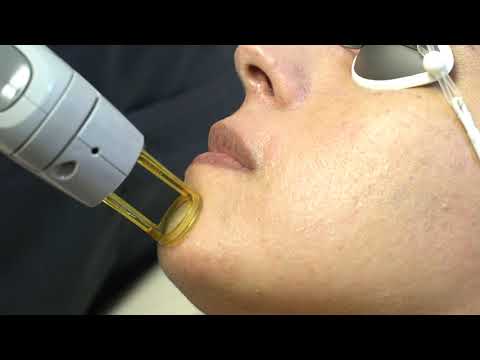 6 Laser Hair Removal for 1 Small, Medium or Large Area w/ Complimentary Visia Complexion Analysis. Save Upto 88% - Second Medium