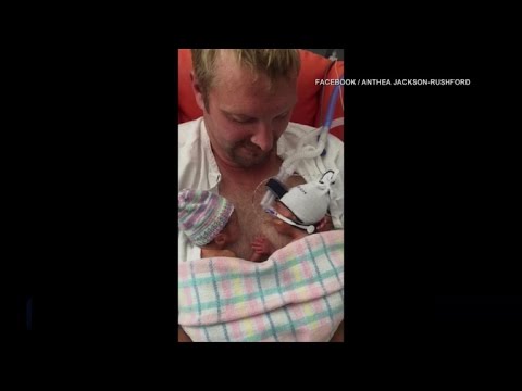Video of premature twins goes viral