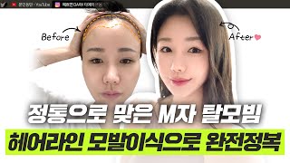 헤어라인 모발이식 리얼 경험담! 넓은 이마 스트레스 끝!ㅣ디에이성형외과ㅣ디에이성형외과의원