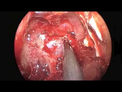 Exposed Carotid Artery at Bony Sella Opening