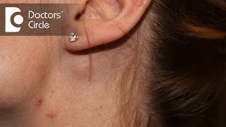 What causes swelling of lymph node near the ear in a young female? - Dr. Satish Babu K