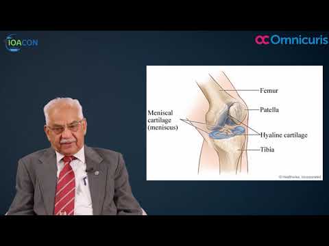 A porckopás (arthrosis) kezelési lehetőségei, Artrózis térd osteoarthrosis