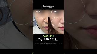 넓은 모공, 제발 포텐자하세요🔥