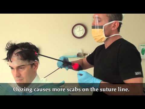 How Does Dr. Brett Bolton Achieve Nearly Invisible Donor Suture Lines? Video
