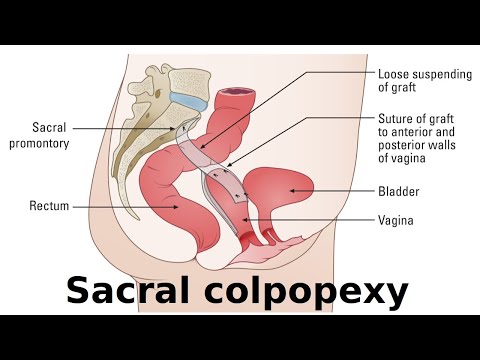 sacral colpopexy