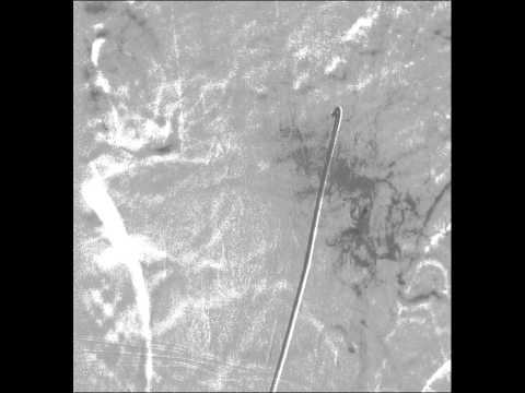 Spinal Dural Fisula Embolization 2 ASA post embo with veins