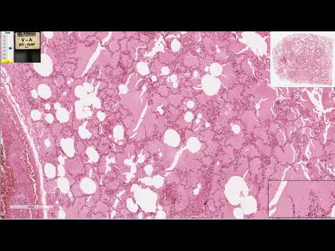 Edema Pulmonar - Patologia Geral