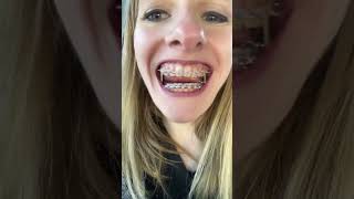 Download lagu Got my braces adjusted and elastics 😃 #keepingitreal #braces #orthodontics #elastics #shorts mp3