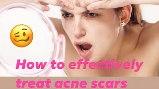 How to Effectively Treat Acne Scars