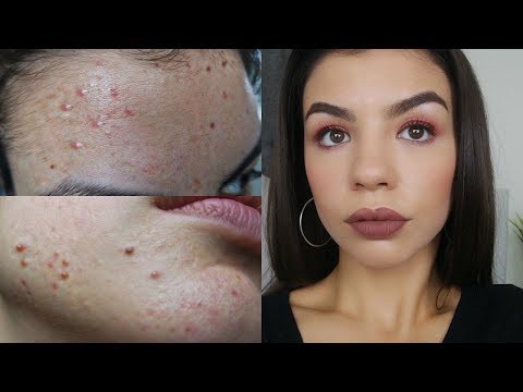 ACNE COVERAGE MAKEUP TUTORIAL AND FOUNDATION ROUTINE 2018
