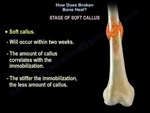 How Does Broken Bone Heal?
