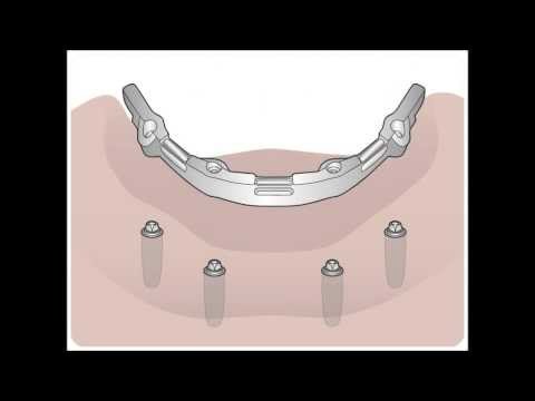 Implantatlösung für zahnlose Kiefer   XiVE TG und CADCAM