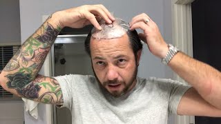 How To Cut Your Hair Where Your Template Goes Using A Hair Replacement Or Hair System