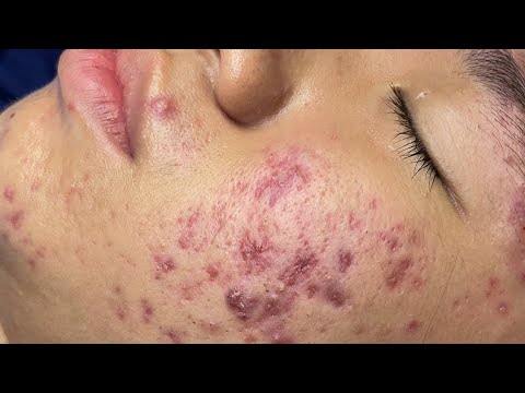 ASMR-Behandlung gegen riesige Akne | Entfernung von Mitessern und Pickeln | Tiefenreinigung #ASMR