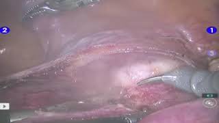 Robotic Hysterectomy for multiple fibroid uterus