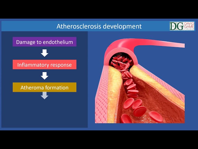 David Game Medical Programme - Atherosclerosis David Game Medical Programme - Atherosclerosis