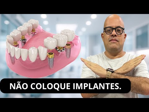 Não Coloque Implantes Antes De Saber Disso! Os Dentistas Não Te Contam A Verdade.