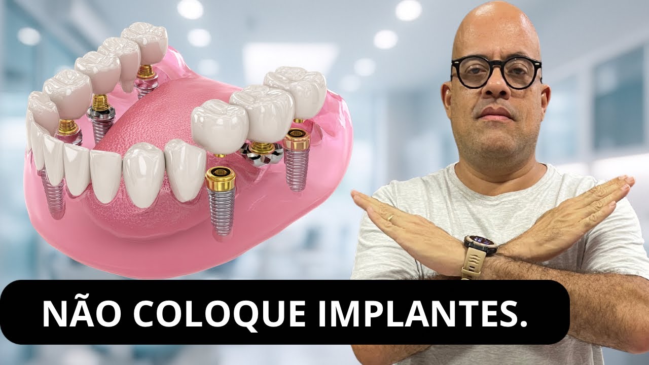 Não Coloque Implantes Antes De Saber Disso! Os Dentistas Não Te Contam A Verdade.